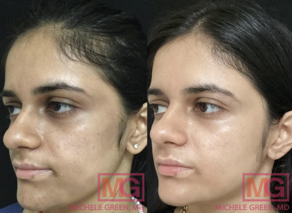 Female treated with Cosmelan & Chemical peels - 12 months