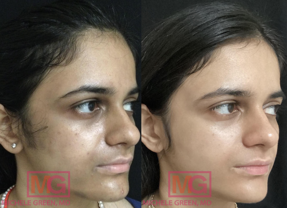 Female treated with Cosmelan & Chemical peels - 12 months
