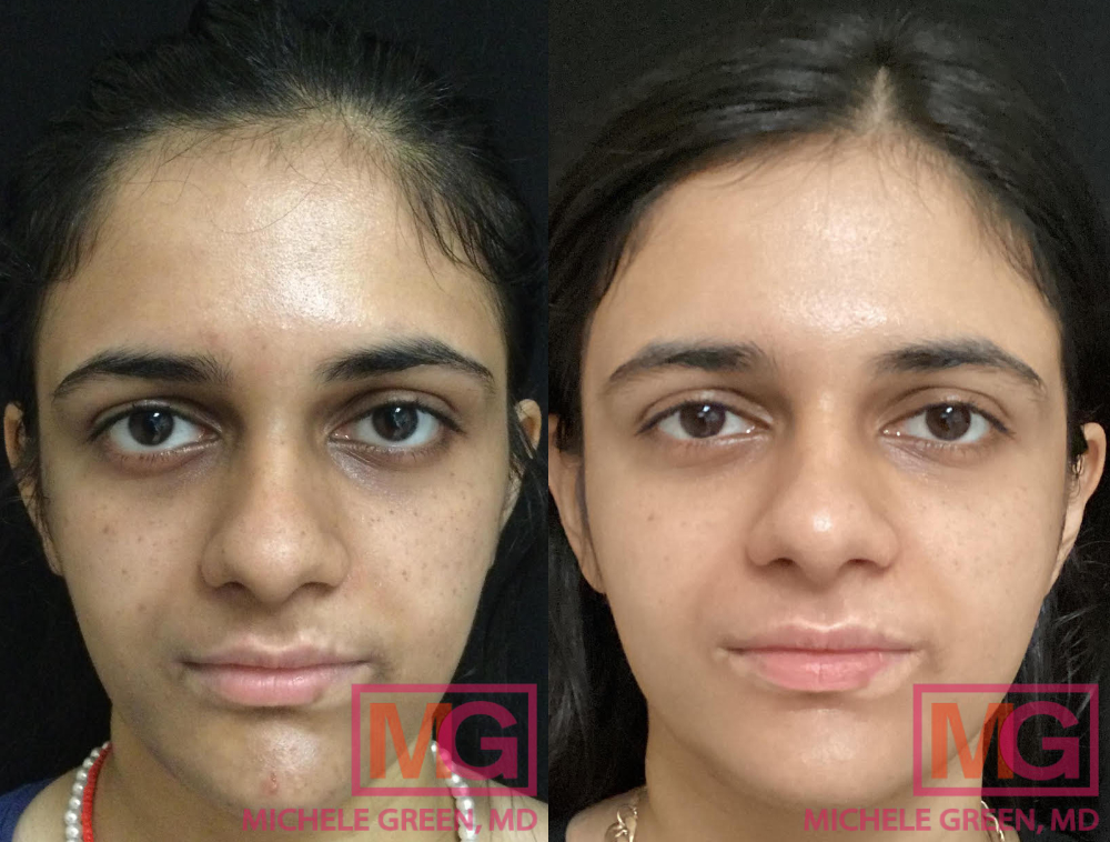 Female treated with Cosmelan & Chemical peels - 12 months