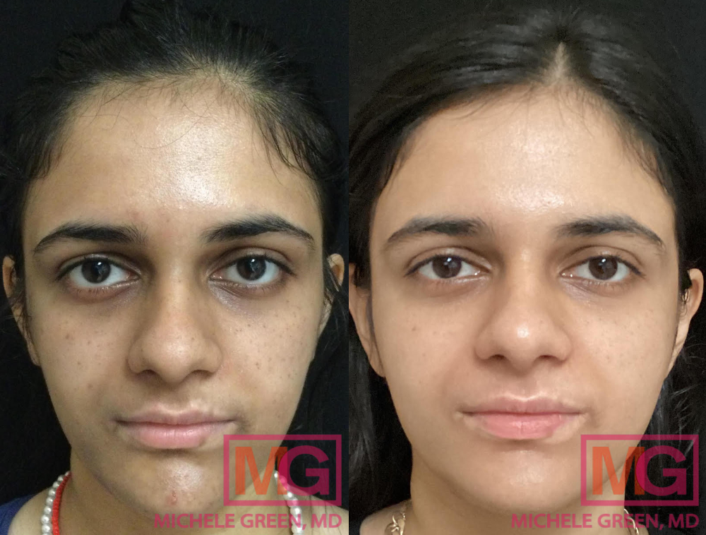 Microneedling Before & After Photos - Dr. Michele Green M.D.