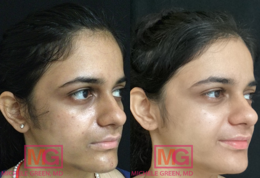 SK before After Cosmelan Peel MGWatermark