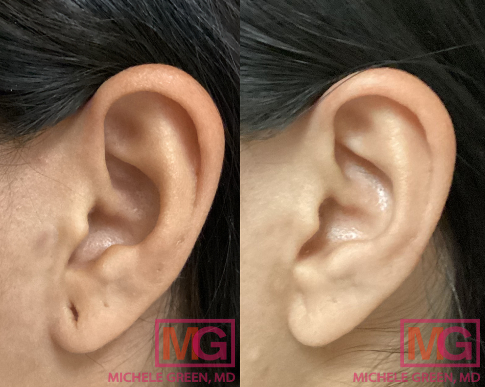 SL 28 yr old female before and after ear lobe repair 2 MGWatermark