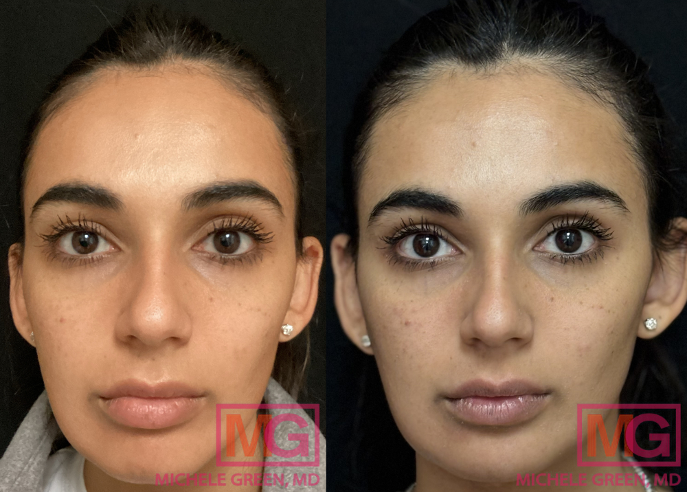 SM Before and After Juvederm XC Lips MGWatermark