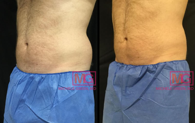 SP 47 male coolsculpting before after angleFLANKS MGWatermark