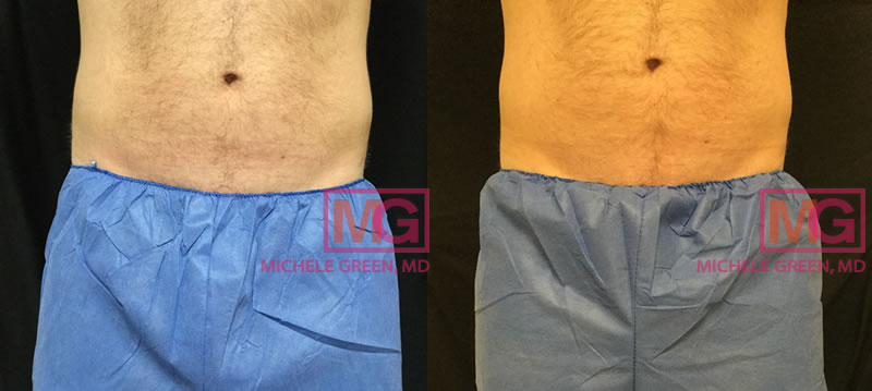 Male CoolSculpting treatment on flanks