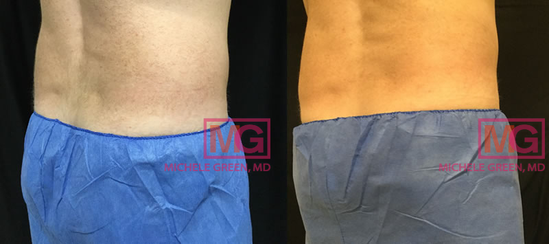 Male CoolSculpting treatment on flanks