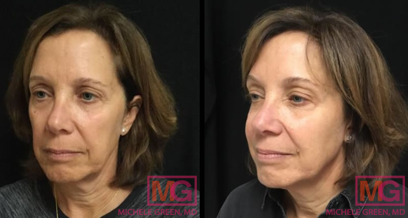 55-64 year old woman treated with Juvederm Voluma for cheeks