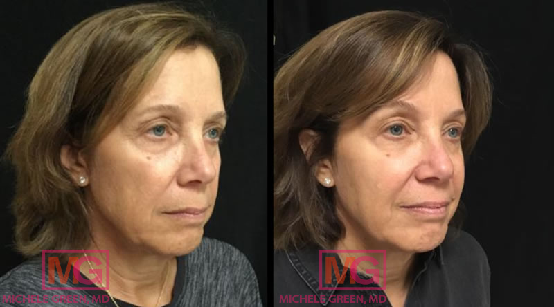 55-64 year old woman treated with Juvederm Voluma for cheeks