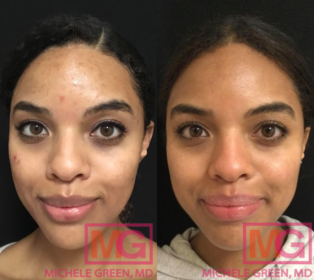 SR 32 yo female before and after 5 months Accutane FRONT MGWatermark