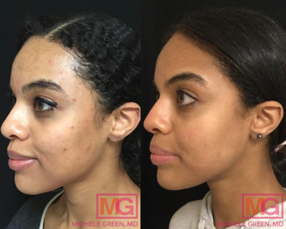 This Woman's Accutane Transformation Photos Went Viral — Before and After  Acne Photos