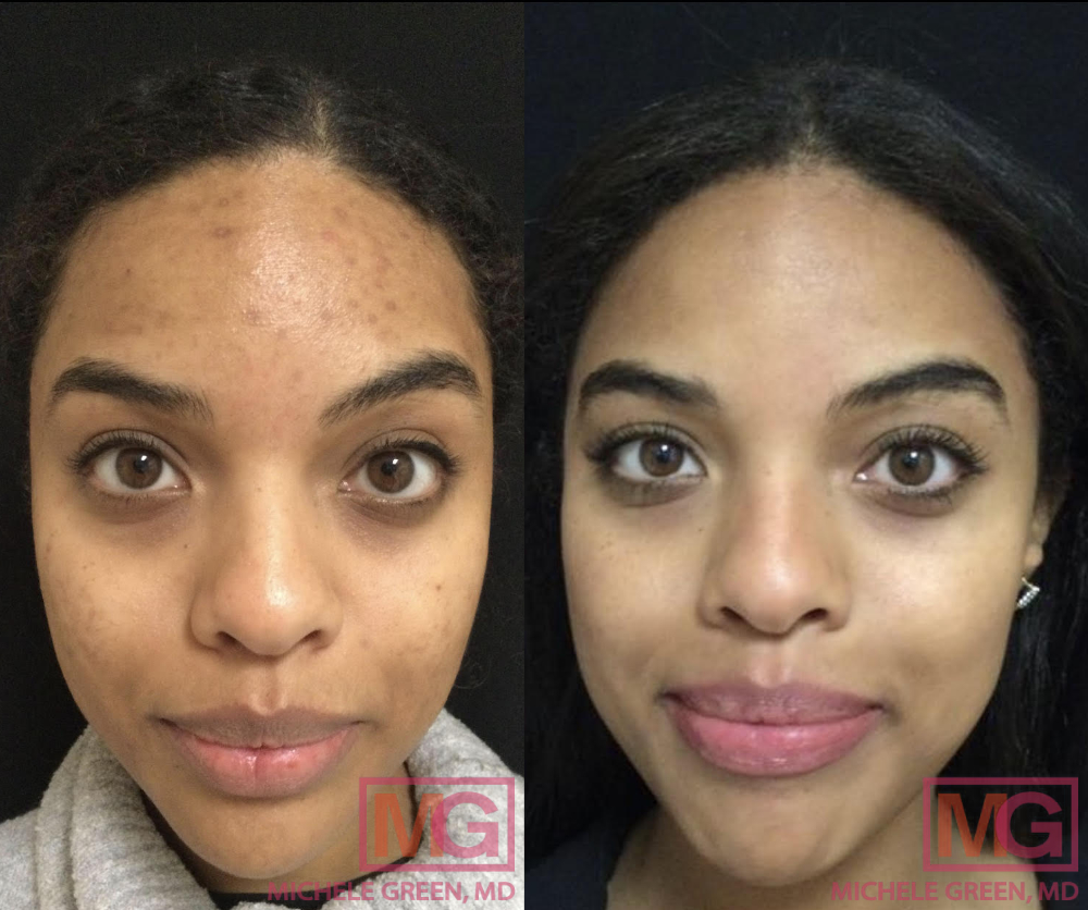 32 yo female before and after acne treatment 10 months