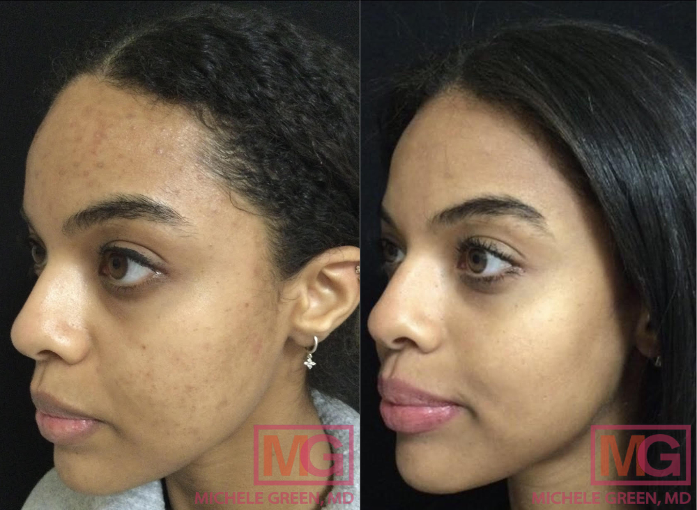 32 yo female before and after acne treatment 10 months