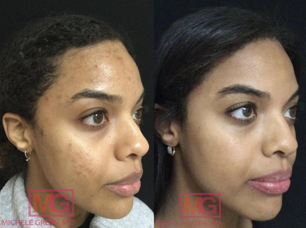 SR 32 yo female before and after acne treatment 10 months RIGHT MGWatermark