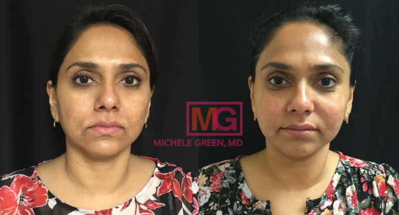 35-44 year old woman, Voluma and Sculptra - 8 months
