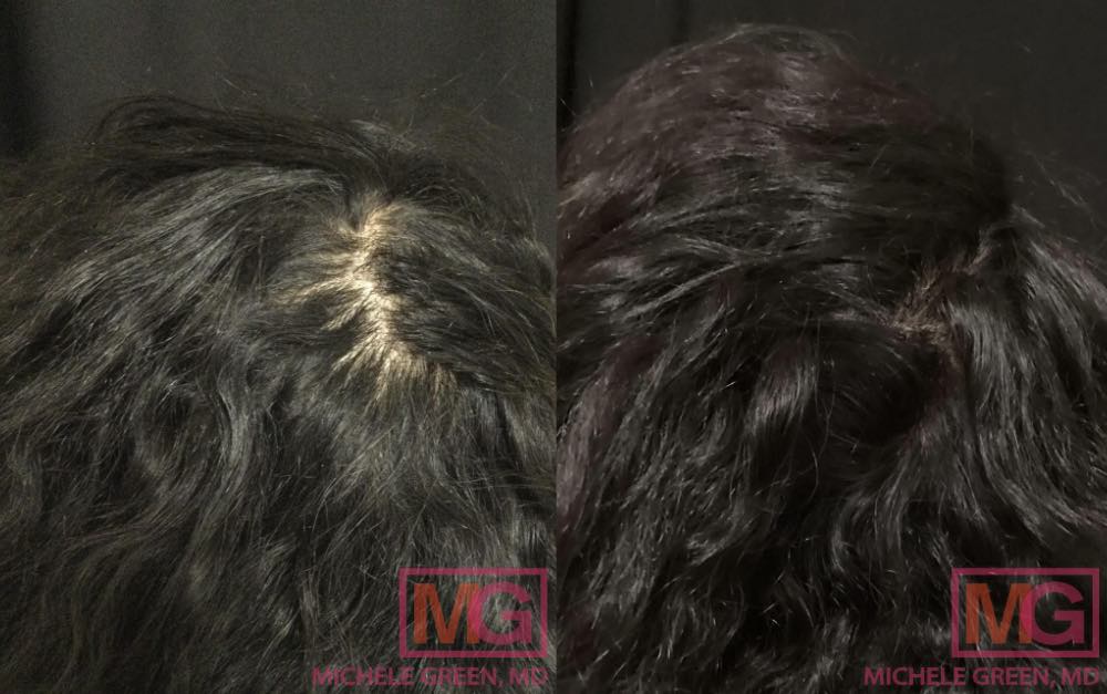 10 months PRP Before and after