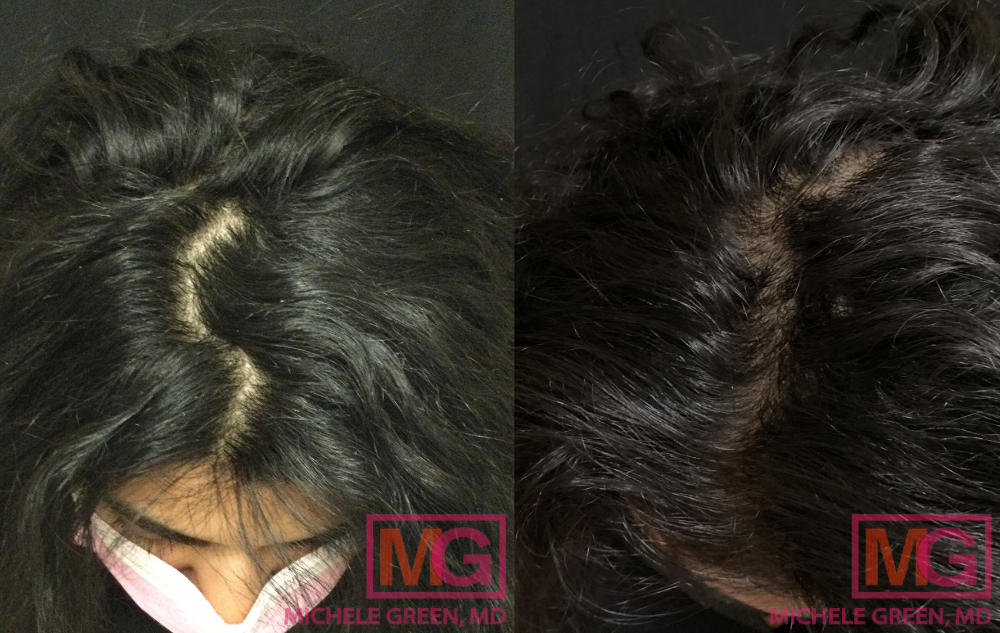 SS 31yo female before After PRP Hair Treatment 1 MGWatermark
