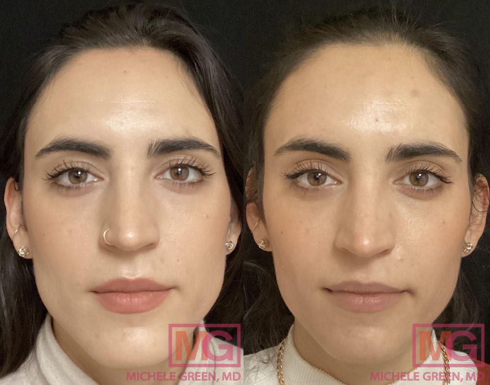 SW 31 yo female before and after botox masseter 1 month apart MGWatermark