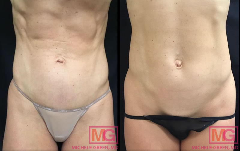 SW thermage abdomen 4m before after FRONT MGwatermark