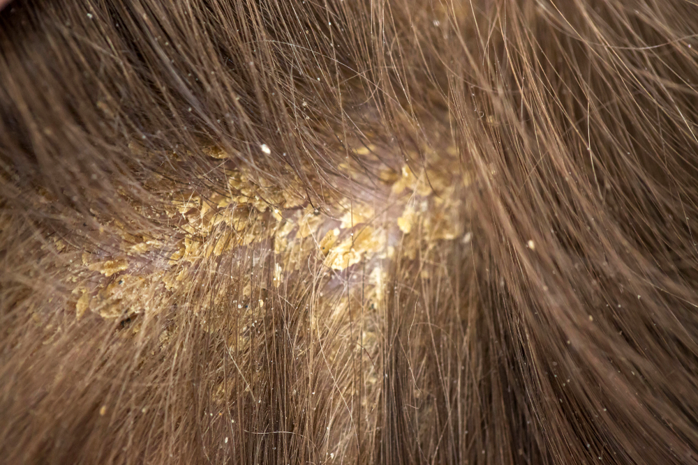 Dandruff,In,The,Hair.,Flaky,Scalp.,Seborrhea.,Macro,Shot.,Children's