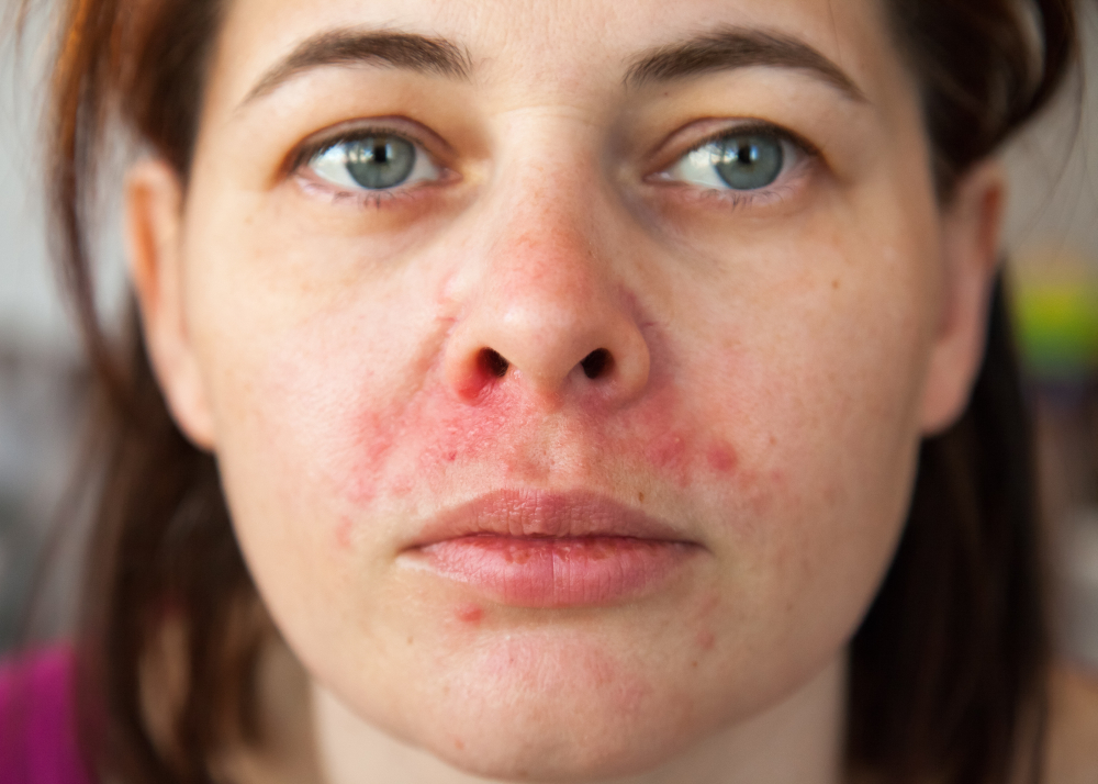 Woman's,Face,With,Perioral,Dermatitis