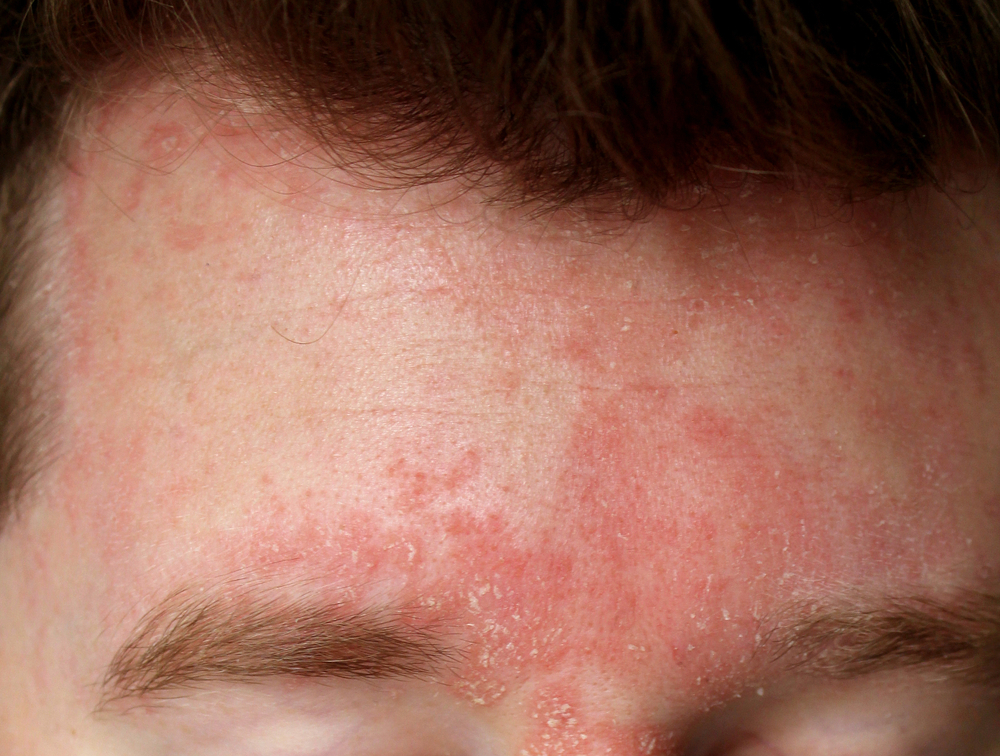 A,Case,Of,Seborrheic,Dermatitis,In,A,Young,Male.