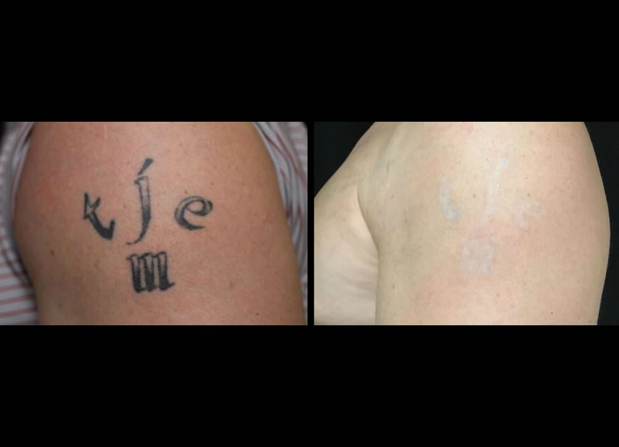 TE tattoo removal before after atv V8 10 Nov18a SQ