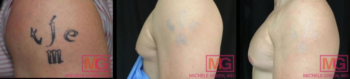 TE tattoo removal before after atv V8 t Nov18b MGWatermark