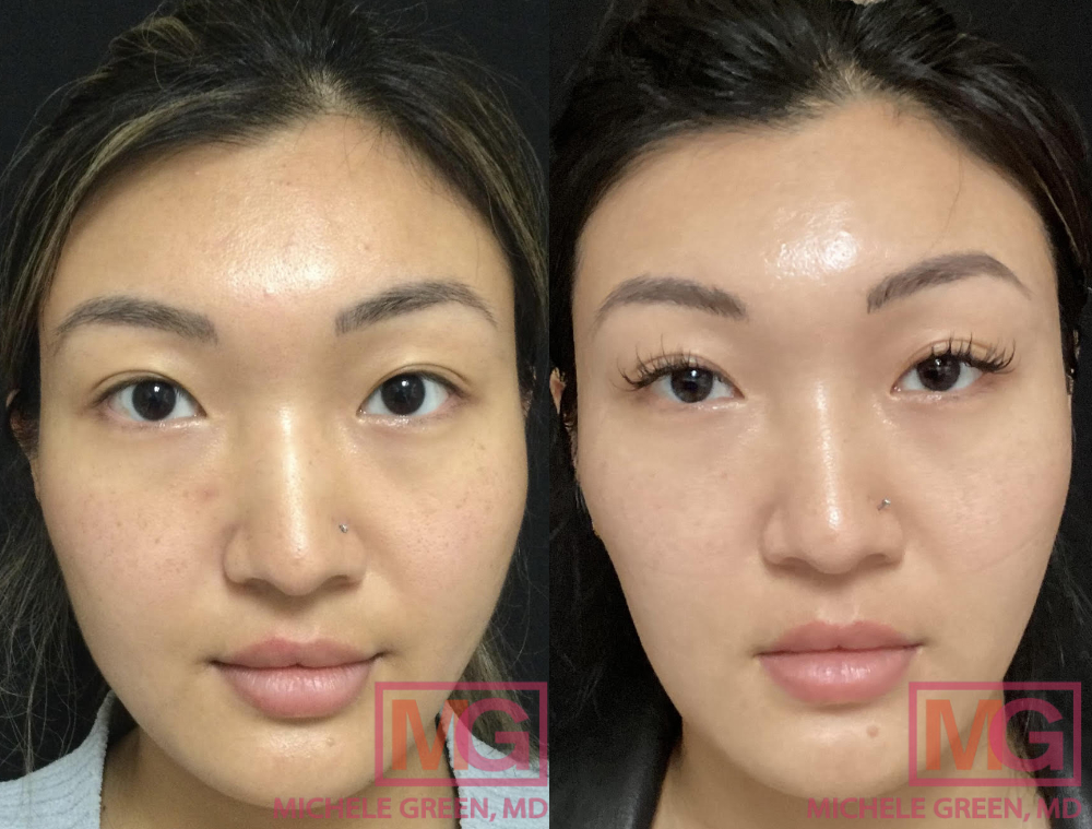 TH 27 yo female before after botox masseter x2 1 year apart MGWatermark