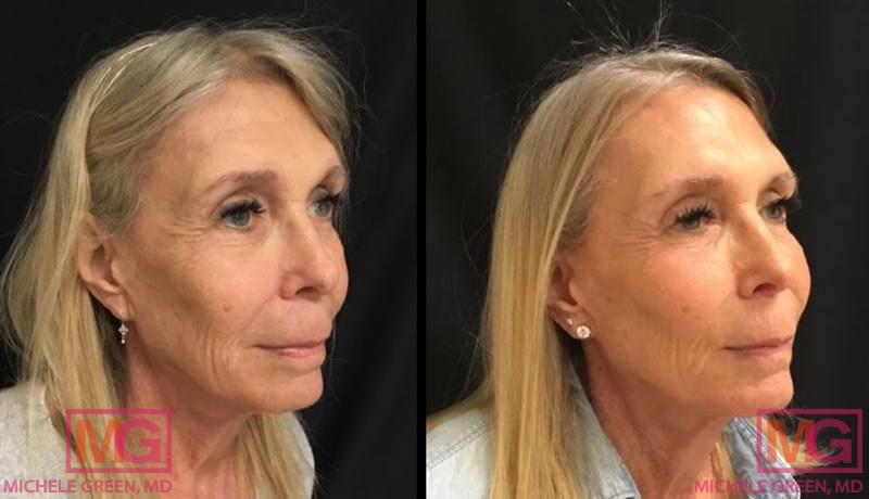 70 year old treated with Sculptra and Voluma