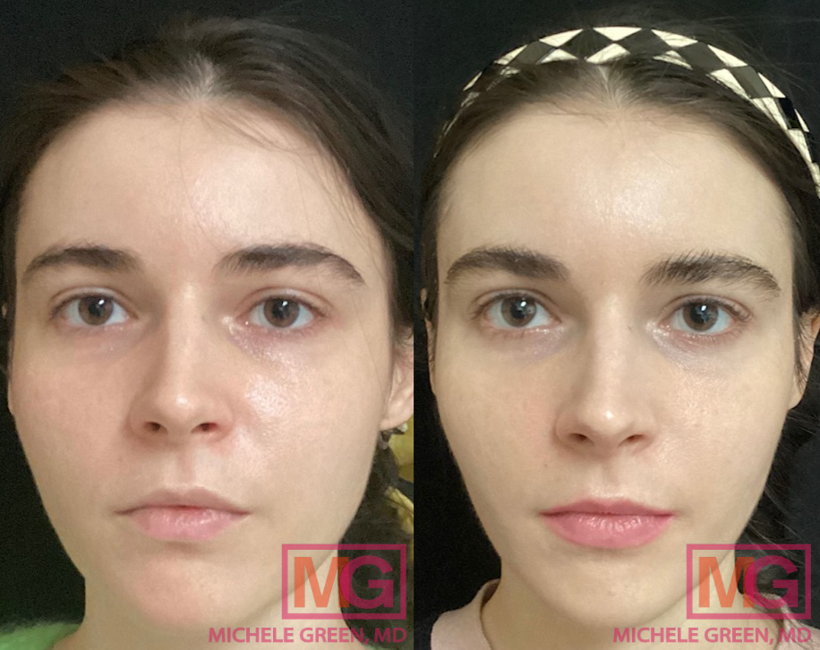 TM 35 yo female before and after Aqua Gold with Botox and Belotero x1 session MGWatermark