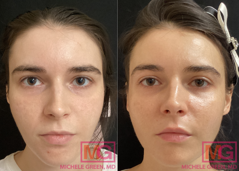 35 year female Before and After 4 vials Sculptra