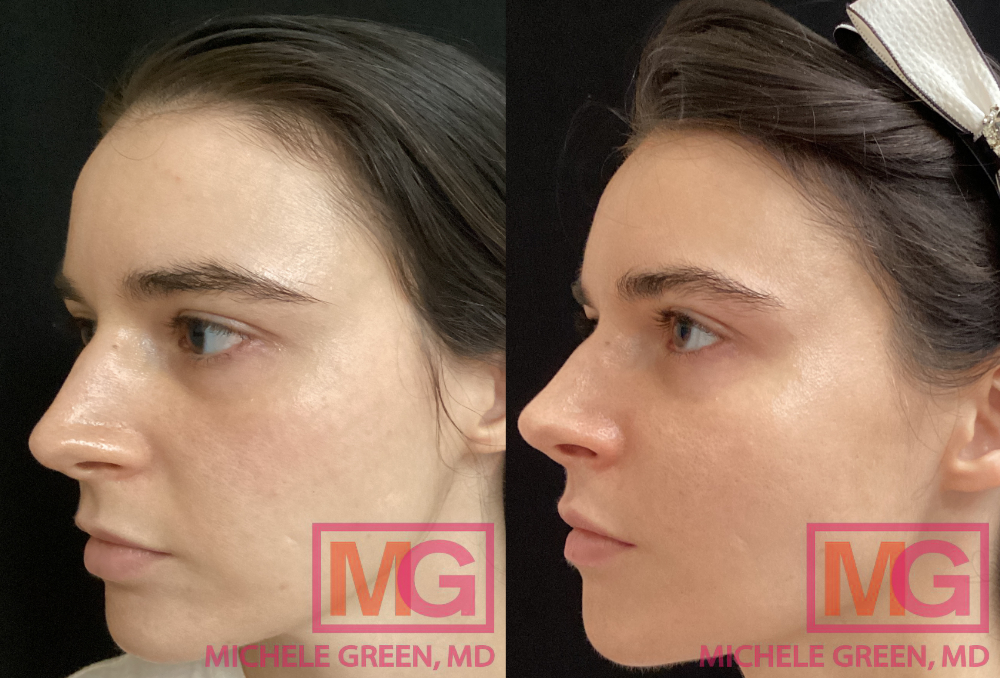35 year female Before and After 4 vials Sculptra