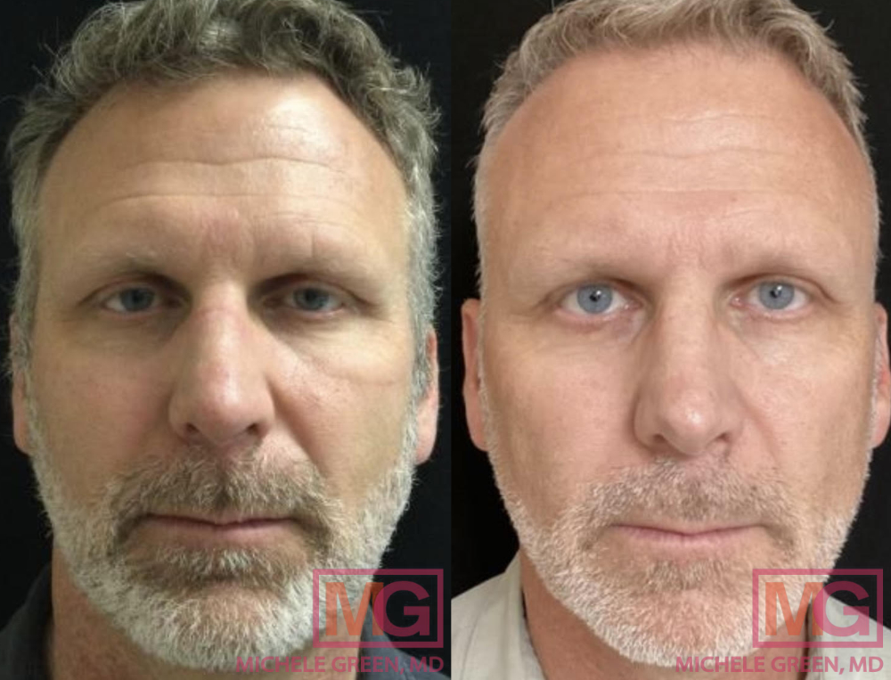 57 year old male before and after Blu Light Treatment