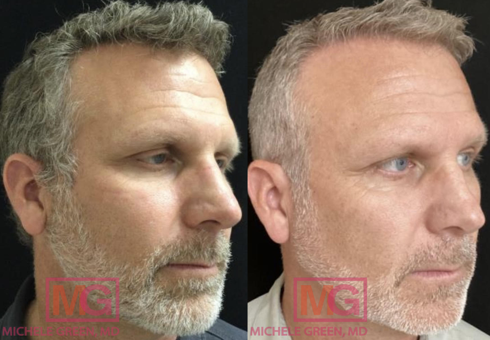 57 year old male before and after Blu Light Treatment