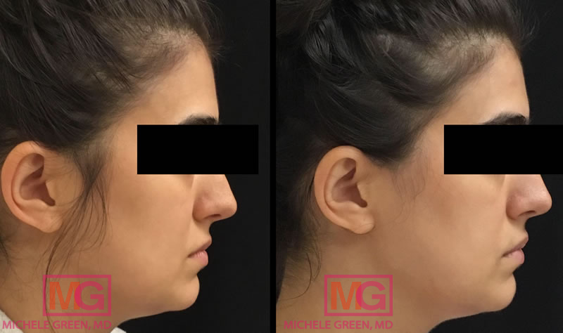 Kybella For Stomach Fat - Dr. Michele Green M.D.