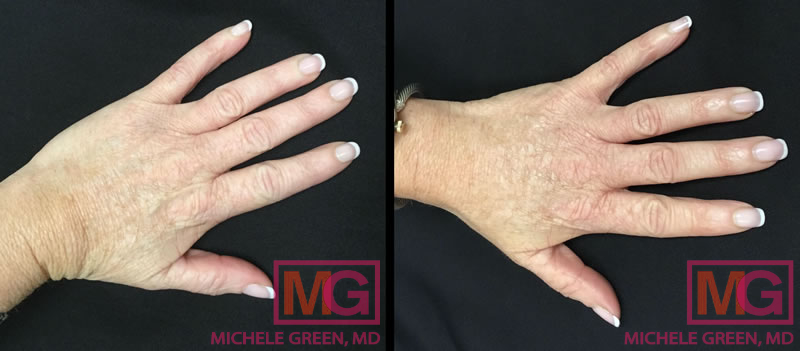 TS hand rejuvenation restylane 3m L3 MGWatermark