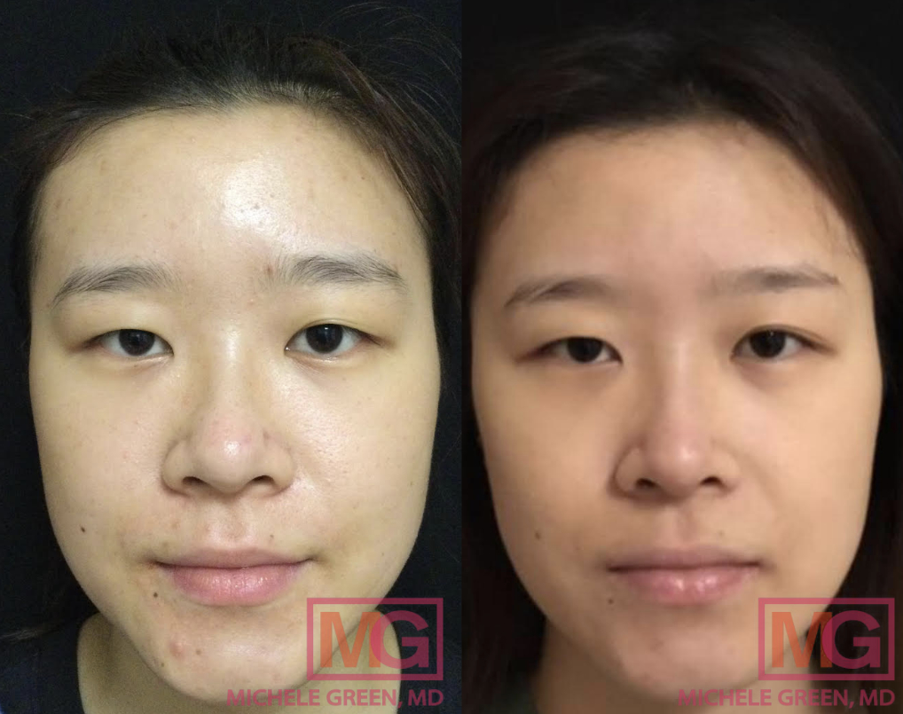 TZ 24 yo female before and after acne 2 months MGWatermark