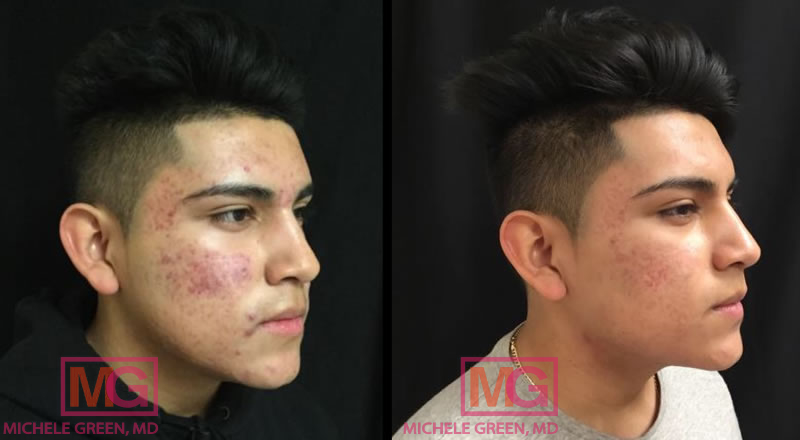 After 5 months of acne treatment with Accutane