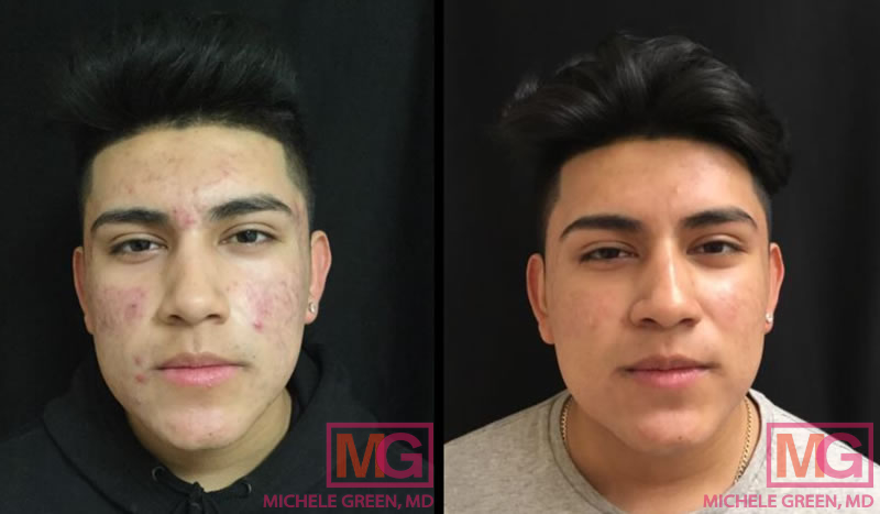 After 5 months of acne treatment with Accutane