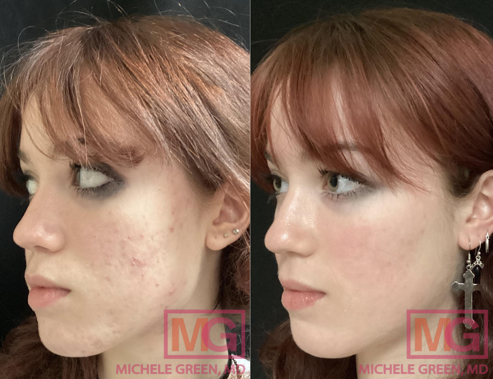 17 year old female, before and after Accutane - 6 months