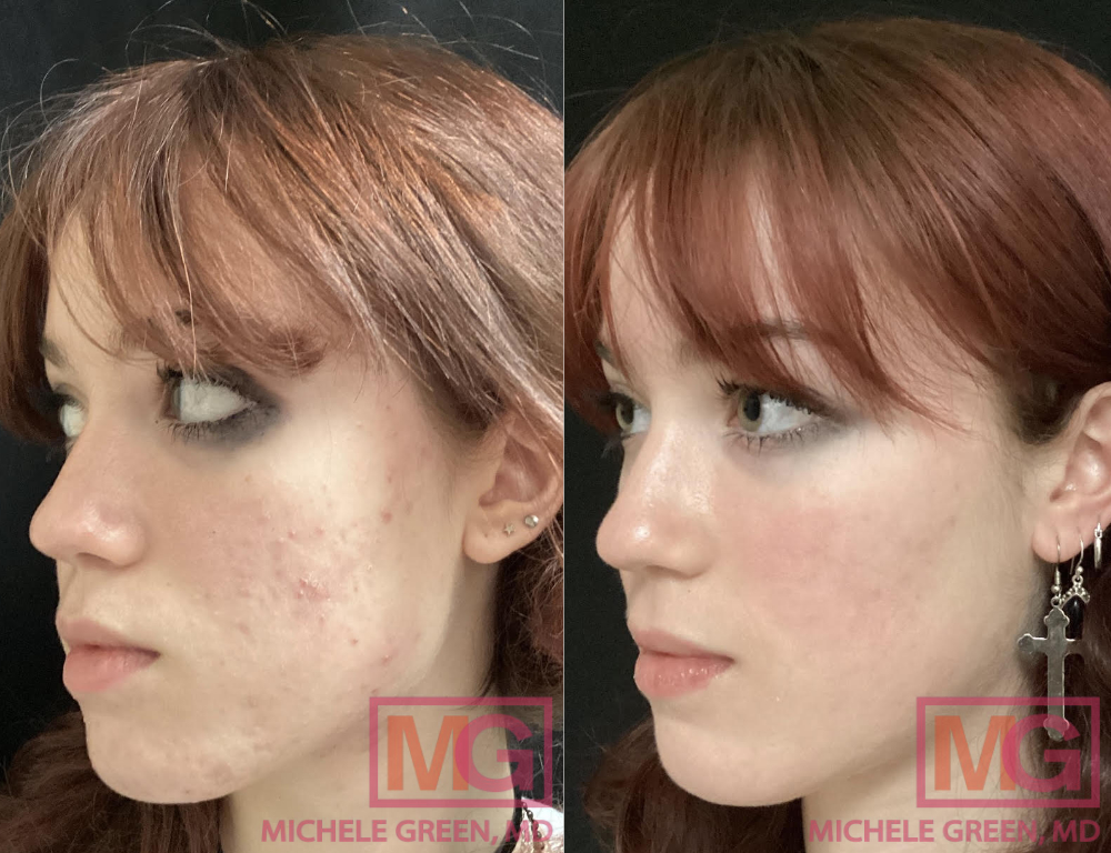 WEBSITE ONLY 17 yo female before and after Accutane x6 months PROFILE RIGHT