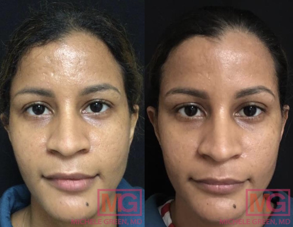 32 yo female before and after 2 syringes Restylane into acne scars 2 months
