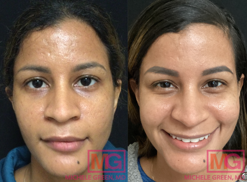 YF 34 year before after Subcision with Restylane Acne Scars MGWatermark