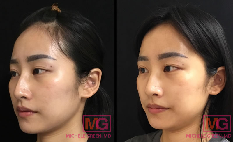 eMatrix for acne scars 1 treatment, 2 weeks before and after