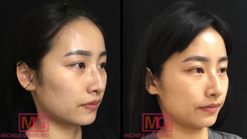 eMatrix for acne scars 1 treatment, 2 weeks before and after
