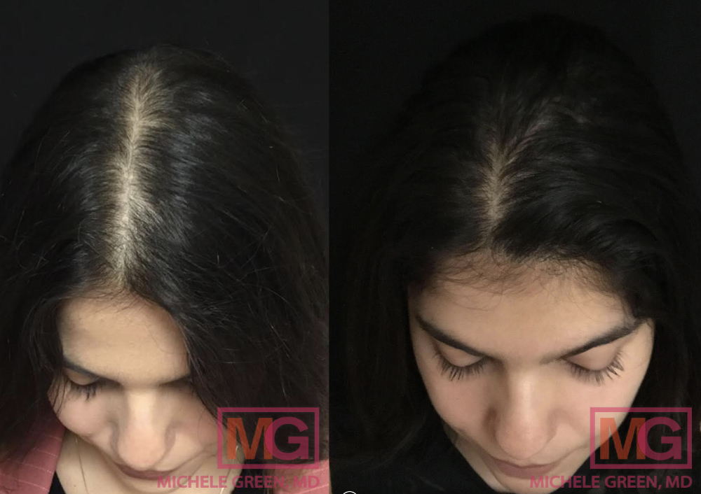 6 PRP treatments, 12 months before and after PRP