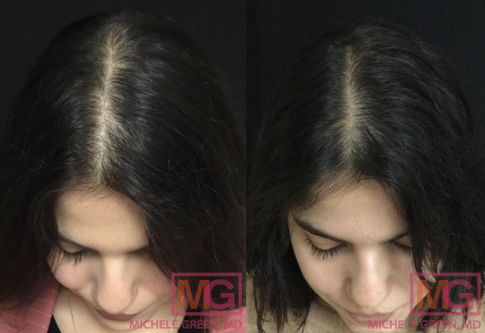 YR Before and after 4 sessions of PRP 10 7 2020 and 1 13 2021 MGWatermark