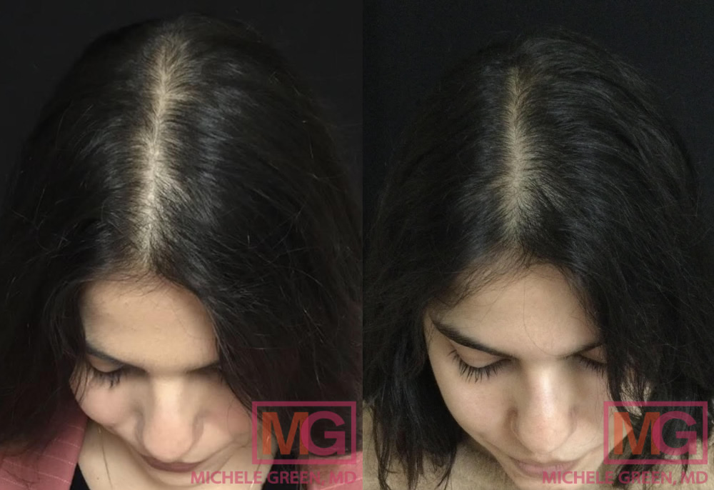 Postpartum Hair Loss, Pregnancy Hair Loss - Dr. Michele Green M.D.