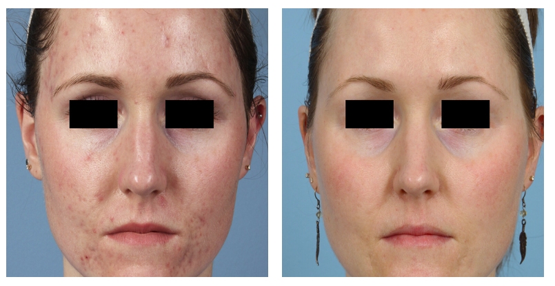 acne before after 3 picosure