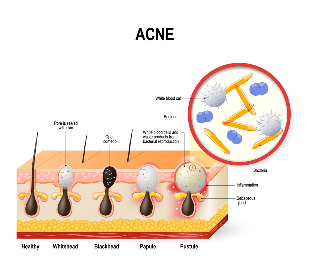 Not all acne or #bacne is the same but if it only started when you